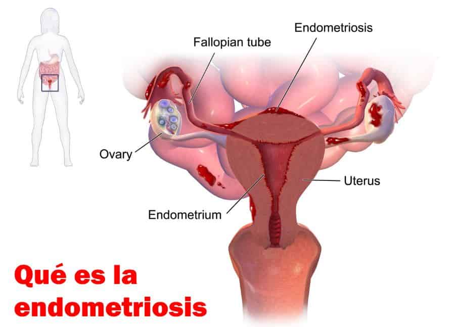que es endometriosis