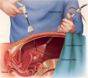 tratamiento de laparoscopia en endometriosis