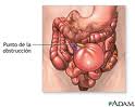 oclusion-intestinal