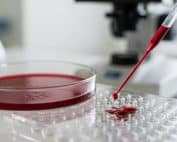 Avance revolucionario: la sangre menstrual acelera el diagnóstico de la endometriosis