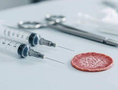 La escleroterapia ofrece una alternativa menos invasiva para el tratamiento de los endometriomas